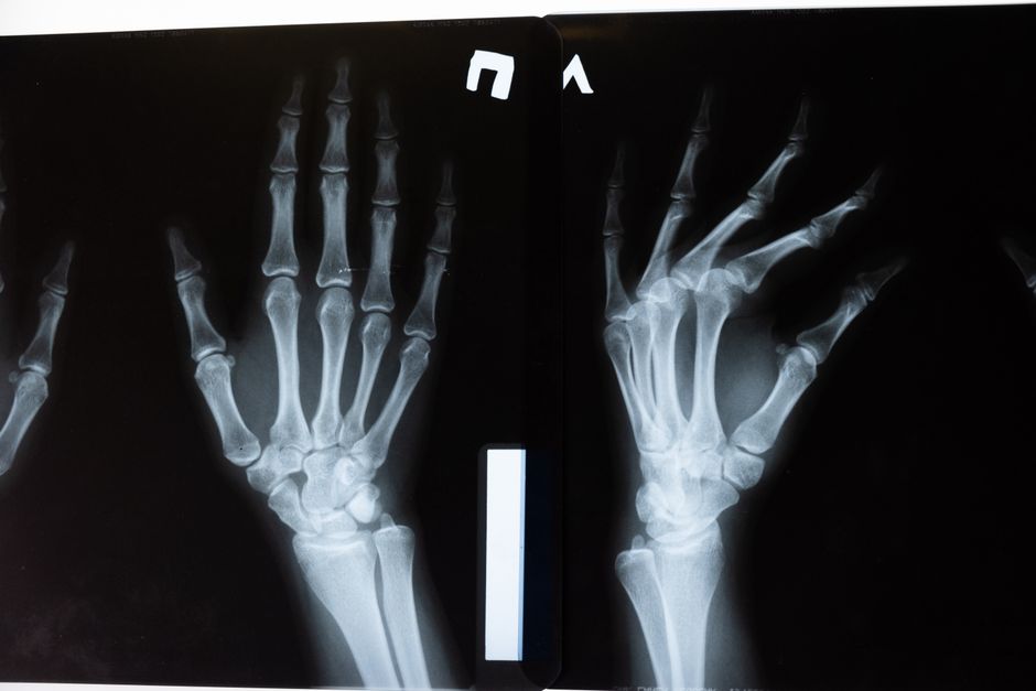 TRT and Bone Density: What Men Over 50 Should Know About Skeletal Health on Testosterone Therapy